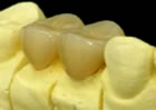 プラスチック冠（小臼歯のみ）の画像