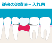 従来の治療法（２）入れ歯