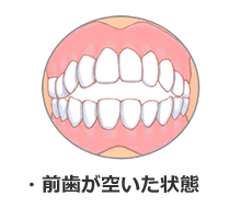 前歯が空いた状態